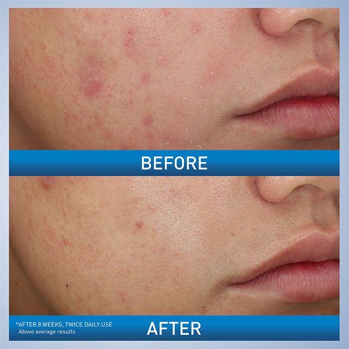 benzoyl-peroxide-face-wash